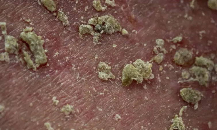 �＾�߷����������صġ�ţƤѢ������ҽ�ӽ��µĿ�ѧ��֪��������Ⱦ��